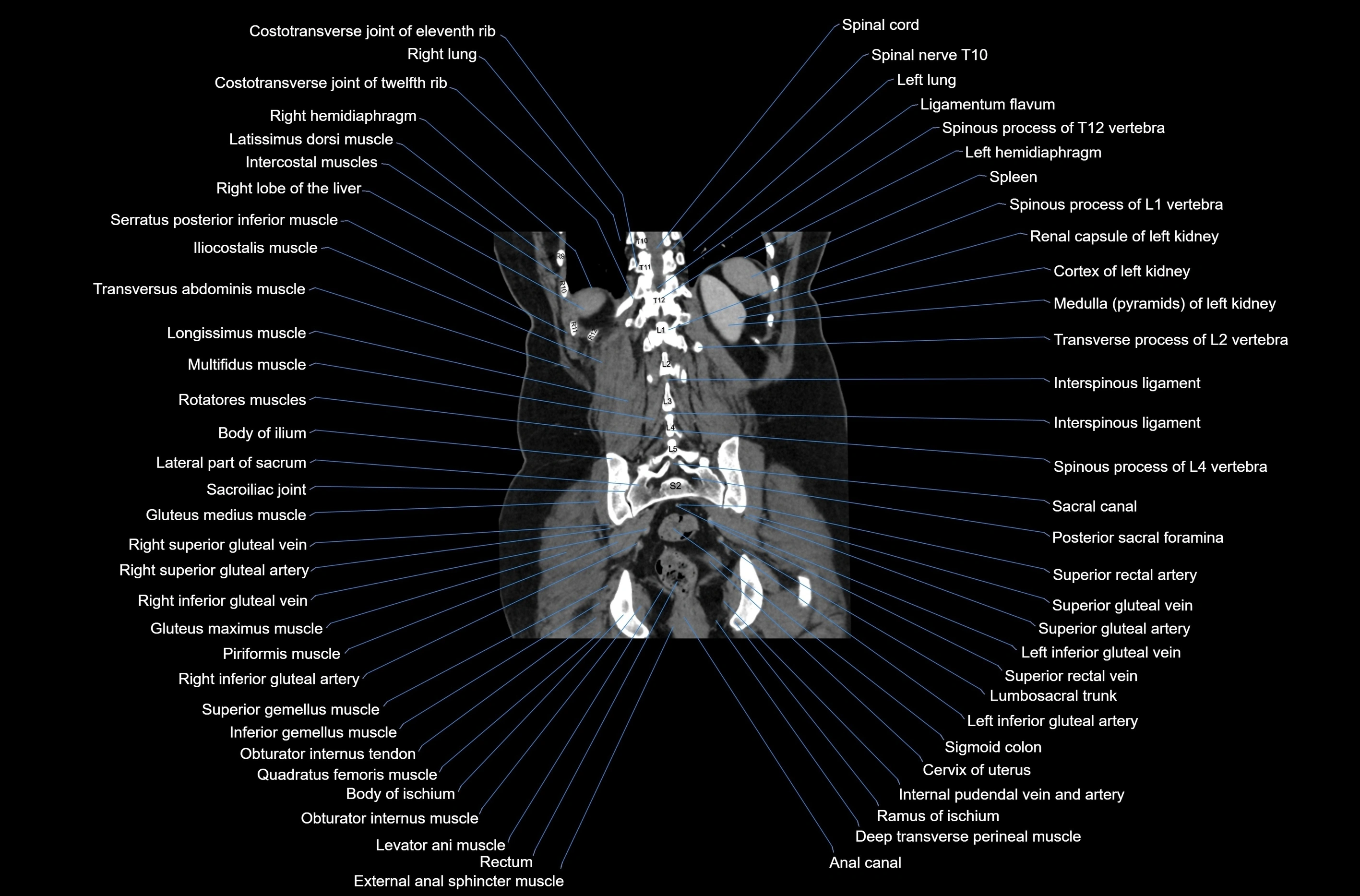 CT abdomen coronal cross sectional anatomy labelled radiology image-00067.webp